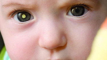 Notícia - Retinoblastoma: diagnóstico precoce é a chave para tratamento